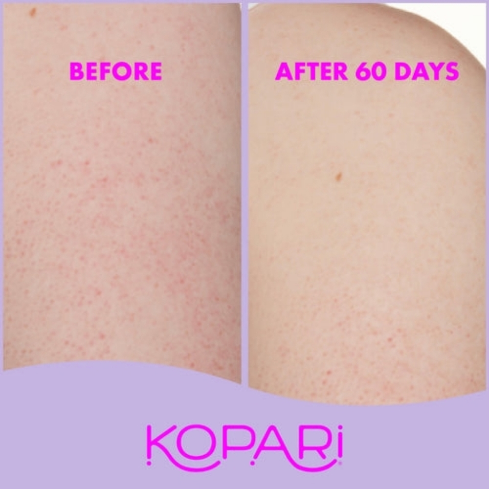 5/$25, Free Gift: Kopari KP Body Bumps Be Gone Scrub w 10% AHA, Jojoba Seed Oil - Picture 5 of 6